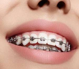 thumb 300 300 dental braces5894