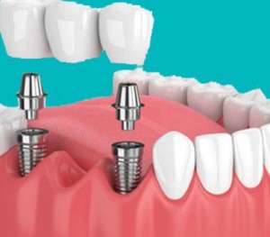 thumb 300 300 dental implant5895