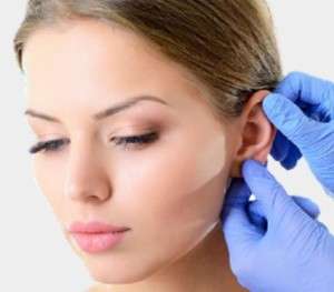 thumb 300 300 ear reshaping surgery otoplasty5905