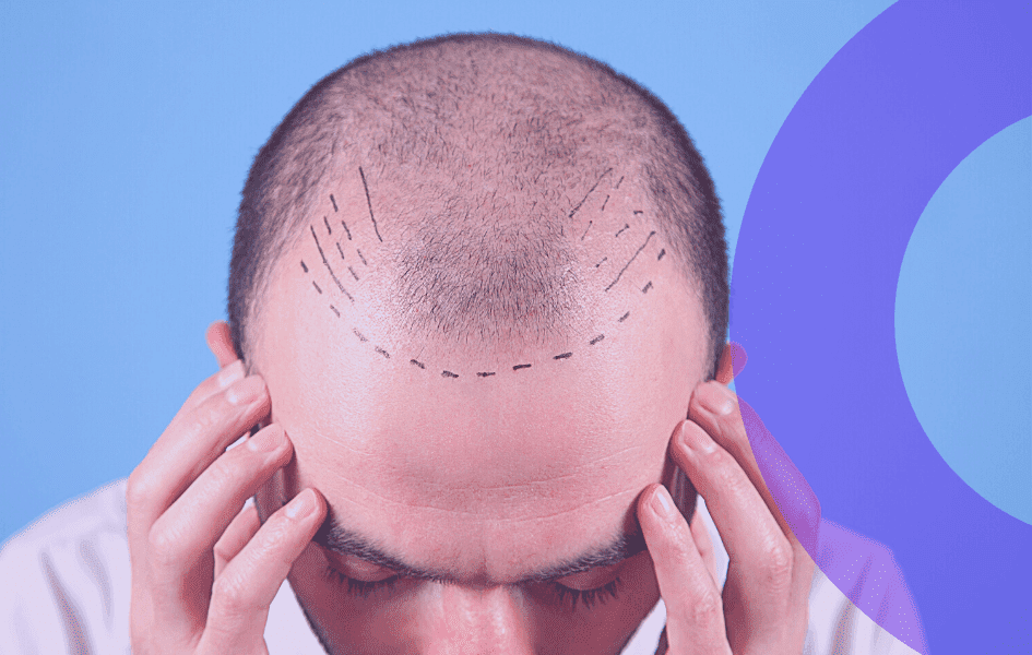 More on Hair Loss