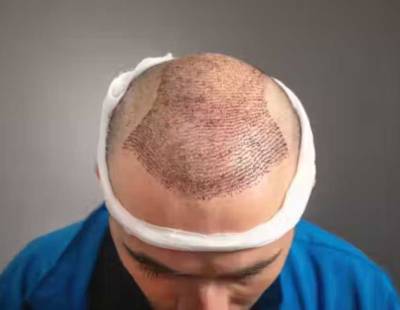 Are You a Hair Transplant Candidate Here is How to Find Out