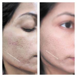 Acne Scar treatment Clinic in Jodhpur