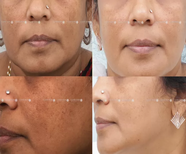 Anti Ageing Treatment Clinic in Jodhpur