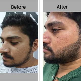 Beard Hair Transplant Clinic in Jodhpur