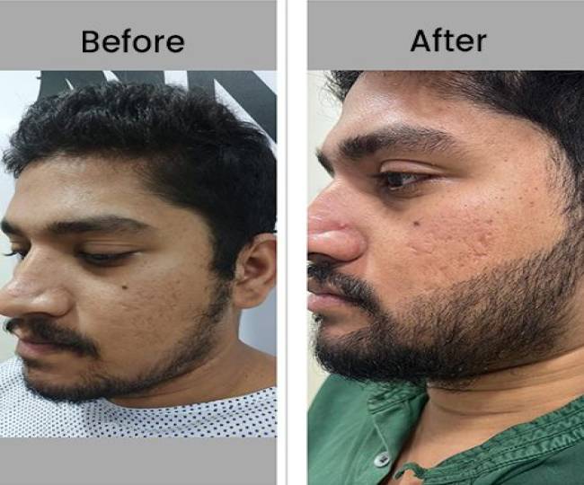 Beard Hair Transplant Clinic in Jodhpur