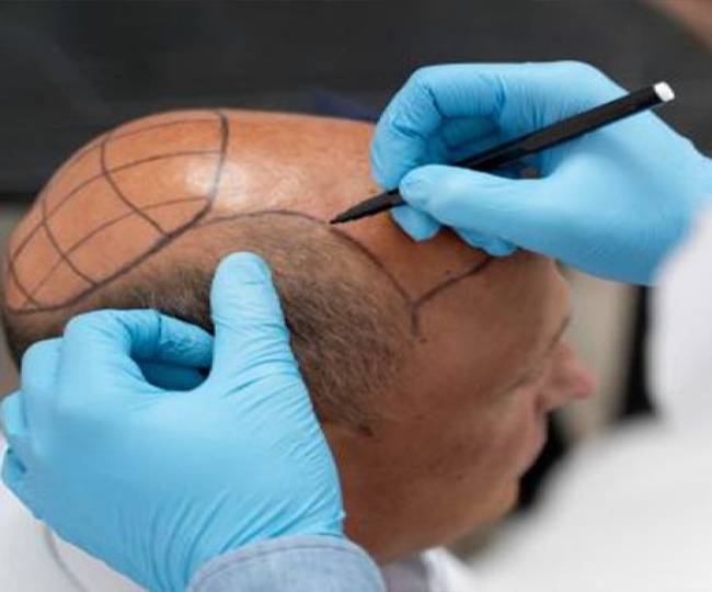 Bio FUE Hair Transplant Clinic in Jodhpur