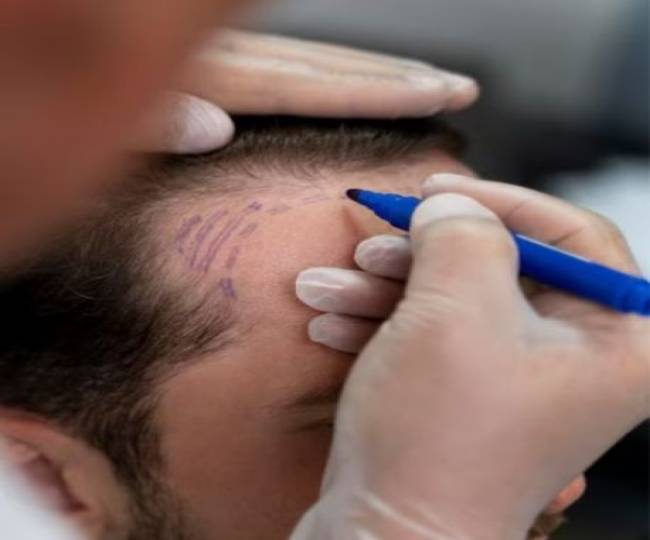 FUT Hair Transplant Clinic in Jodhpur