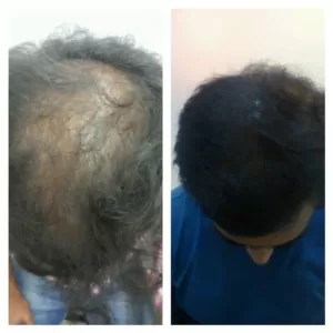 Hair Fall Treatment Clinic in Jodhpur