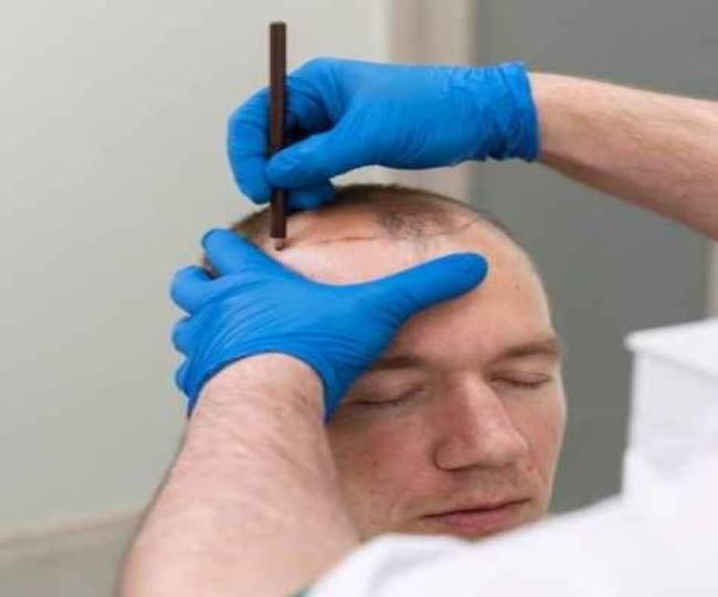 Hair Transplant Cost Clinic in Jodhpur