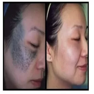 Laser Birthmark Removal Clinic in Jodhpur