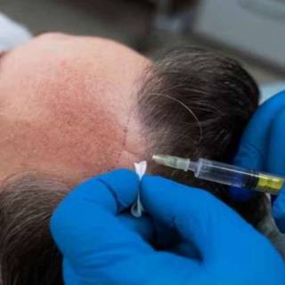 MDFI Hair Transplant Clinic in Jodhpur