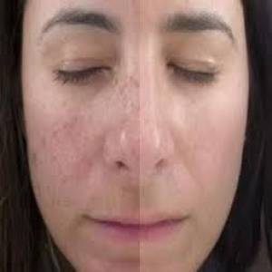 Photofacial Treatment Clinic in Jodhpur