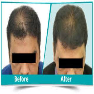 Scalp Rejuvenation Clinic in Jodhpur