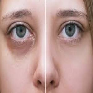 Under Eye Dark Circle Treatment Clinic in Jodhpur