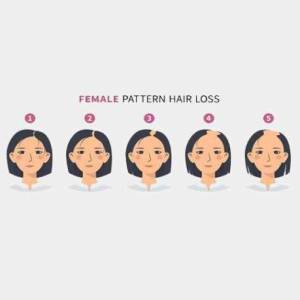 Women Female Hair Transplant Clinic in Jodhpur