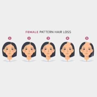 Women Female Hair Transplant Clinic in Jodhpur